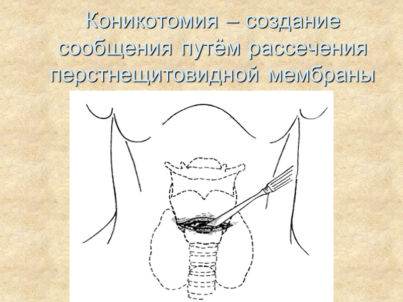 Коникотомия – создание сообщения путём рассечения перстнещитовидной мембраны